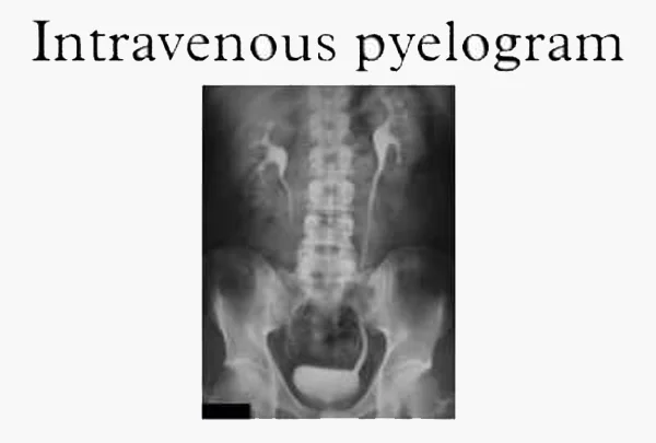 Intravenous Pyelogram