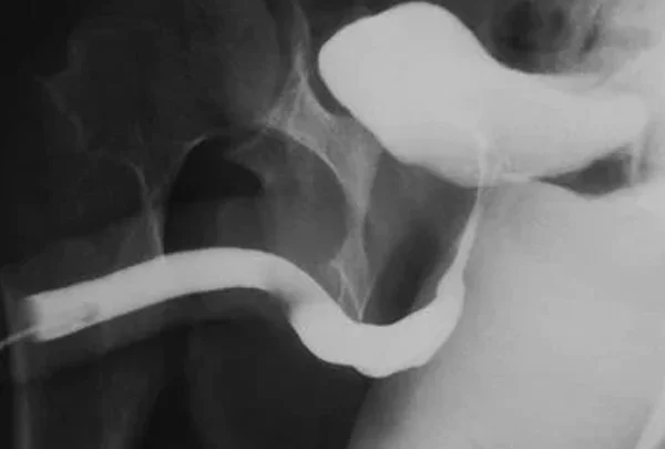 Retrograde Urethrogram