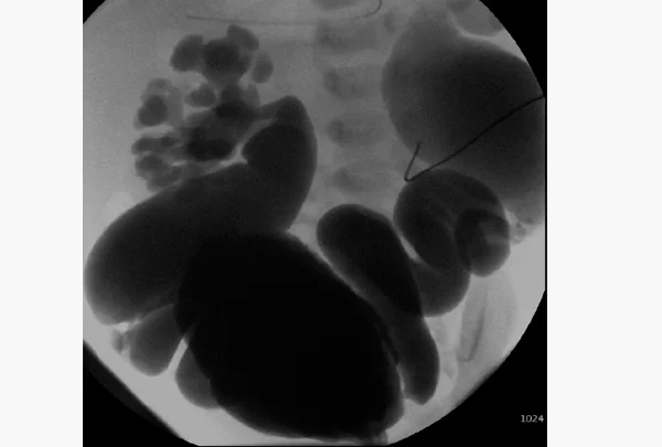 Micturating Cystourethrogram