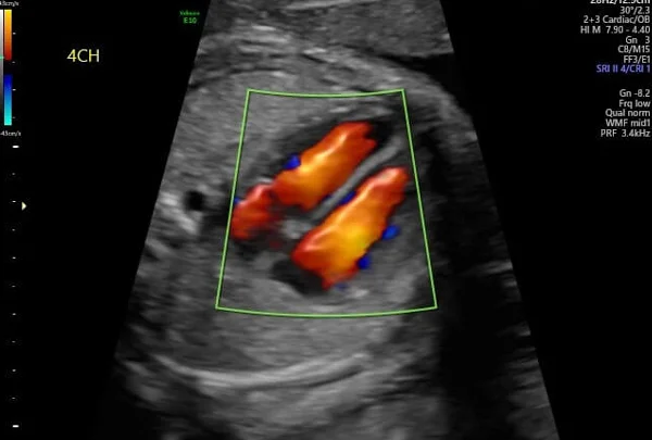 Fetal Echo