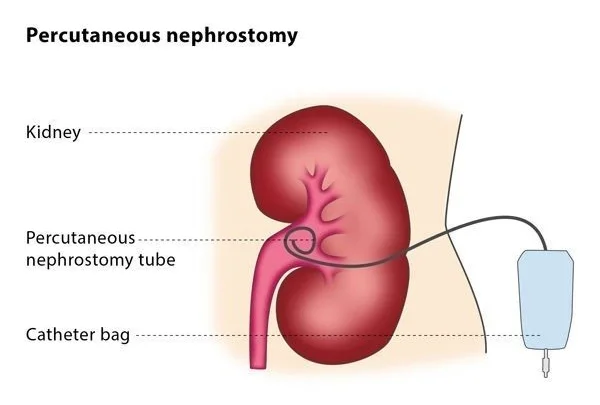 Percutaneous Nephrostomy