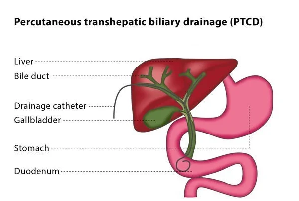 Percutaneous Transhepatic Biliary Drainage