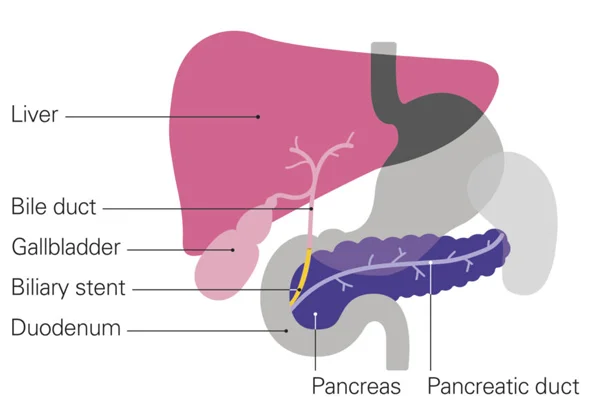 CBD Stenting