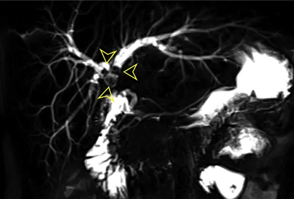 HJ Stricture Dilatation